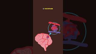 Brain Aneurysm Bleeding [upl. by Tybi]