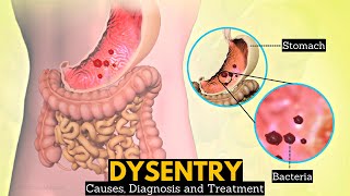 What is Dysentery Causes Signs and symptoms Diagnosis and treatment [upl. by Ahsilak]