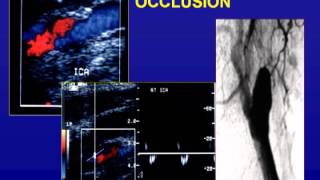 Ultrasound of the Carotid Arteries [upl. by Luigino]