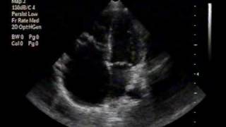 echocardiogramEbstein anomaly apical 4chamber view [upl. by Rochemont831]