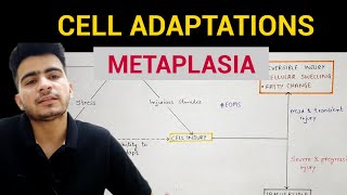 Metaplasia  Cell Adaptations 33  General Pathology  EOMS [upl. by Kale]