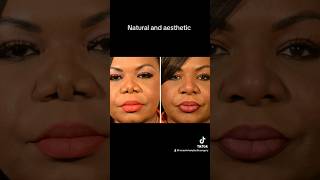 Revision African American Rhinoplasty— by Dr Narasimhan  patient scarred from previous surgery [upl. by Aihsik]