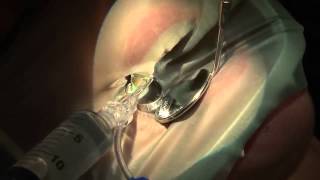 DTC  Root Canal Treatment Endo [upl. by Morez]