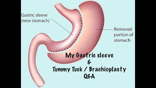 My Gastric Sleeve  Brachioplasty amp Tummy Tuck Surgery QampA [upl. by Annalla]