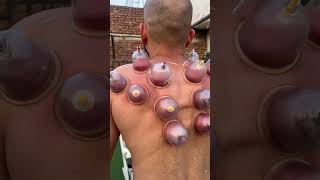 Cupping for back pain [upl. by Ztnahc]