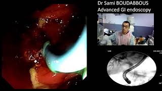 ERCP for pancreatic cancer [upl. by Mamoun]