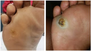 Unfortunately Its Back 😱 UPDATE on My Plantar Wart Callus Pitted Keratolysis [upl. by Miles]