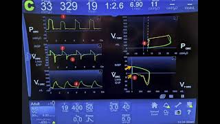 Analysis and Interpretation of Ventilator Graphics Including Loops [upl. by Hgeilhsa598]