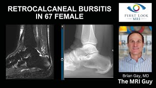 Heel pain from retrocalcaneal bursitis [upl. by Gebhardt102]