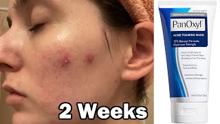 I tried panoxyl face wash for 2 weeks to clear my acne [upl. by Nnahteb]