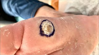 Callus removal from feetampFoot scraping dead skin 【Xiao Yan Pedicure】125 [upl. by Amarette]