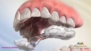 Orthodontic Expander or Spacer  Bonded RPE Appliance [upl. by Kampmeier]