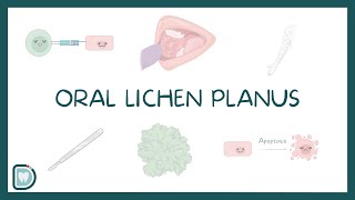 Oral Lichen Planus Causes Diagnosis Types and Management [upl. by Arekahs126]