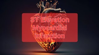 ST Elevation Myocardial infarction ppt [upl. by Morna]