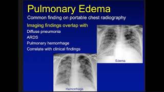 edema atelectasis and consoldiation [upl. by Ceporah]