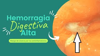 Riesgos de los Antiinflamatorios Úlceras y Hemorragia Digestiva Alta [upl. by Llerut]