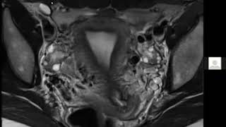 Hydrocele of the Canal of Nuck  Dr Roopa Ram [upl. by Wauters650]