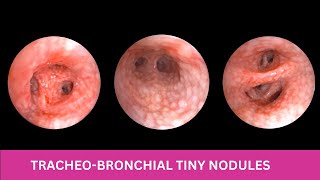 TRACHEOBRONCHIAL NODULES  Cobblestone Appearance [upl. by Eiral]