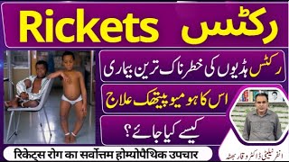 Rickets رکٹس सूखा रोग Homeopathic Treatment By Dr Waqar Bhutta In Urdu  Hindi [upl. by Nnahgiel]