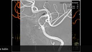 Angioplastia Intracraneal Gateway  Wingspan [upl. by Ina]