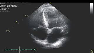 Amyloid Cardiomyopathy with Restrictive Filing [upl. by Haroppiz]