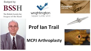 MCPJ Arthroplasty by Prof Ian Trail [upl. by Brittaney]