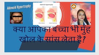 Adenoid Hypertrophy  नाक के पीछे गांठ बच्चों में मुंह खोल के सांस लेना  खराटे बच्चों में [upl. by Atsirtal235]