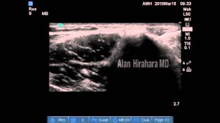 Ultrasound guided injection  Lateral epicondylitis PRP inplane [upl. by Nodnil]