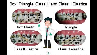 Triangle Box Class II and Class IIII Elastics [upl. by Etana]