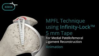 MPFL Technique using InfinityLock™ 5 mm Tape [upl. by Nichola61]