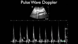 Ultrasound Physics Scanning Modes Pulsed Wave Doppler [upl. by Buddy]