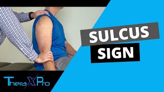 Sulcus Sign  Shoulder Instability [upl. by Shaddock]