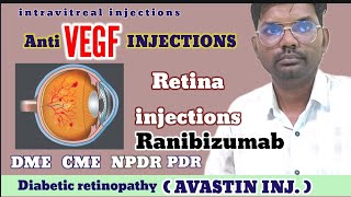 Anti vegf injections  avastin injections  Ranibizumab injections  Bevacizumab injections  vegf [upl. by Kristina]