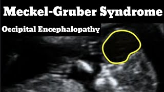 Sonographic Signs of MeckelGruber syndrome [upl. by Airreis]