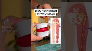 DISC HERNIATION INAVYOTOKEA [upl. by Clements]