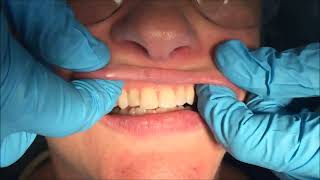 Intraoral Examination [upl. by Norrek]