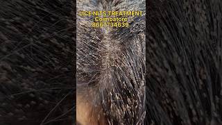 lice Treatment in parlour  lice nits treatment now available in chennai coimbatore  💯 result [upl. by Zirtaeb]