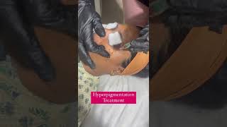 Hyperpigmentation Treatment viralshorts trending shortvideos [upl. by Neibaf]