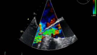 SEVERE AORTIC REGURGITATION  RHEUMATIC DISEASE ECHOCARDIOGRAPHY cardiac ultrasound [upl. by Bourque603]