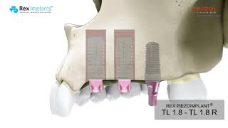 IMPLANTOLOGY  REX ANIMATION  Rexpander® technique [upl. by Aisanat118]