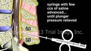 Epidural Spinal Anesthesia  Animation by Dr Cal Shipley MD [upl. by Poul559]