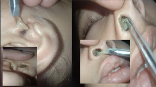 Baby booger and baby ear wax [upl. by Yenahteb]