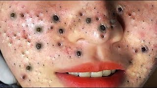 Big Cystic Acne Blackheads Extraction Blackheads amp Milia Whiteheads Removal Pimple Popping  614 [upl. by Haneehs]