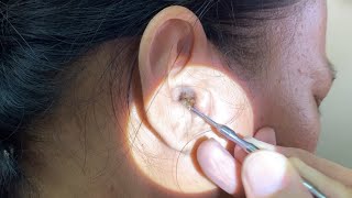 Massive Hard Dry Earwax Removed from Womans Ear [upl. by Waldack354]