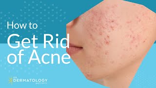 Acne Treatment  Explained by Dermatologist [upl. by Ahsykal]