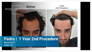 2nd Hair Transplant Results for Male Pattern Baldness Norwood 3  Dr Huebner Pedro [upl. by Initof]