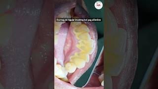 Is dental scaling harmful dentalscaling toothcleaning [upl. by Mellen128]