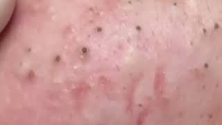 3th January 2024 ACNE BLACKHEADS REMOVAL SPA SKIN CARE blackheads blackheadsremoval [upl. by Gerek]