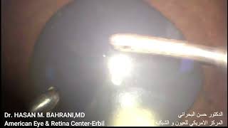 Anterior Chamber Silicon oil removal iridectomy [upl. by Suiramaj]