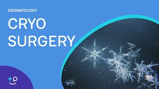 Cryo Surgery Procedure Freezing [upl. by Ariayek987]